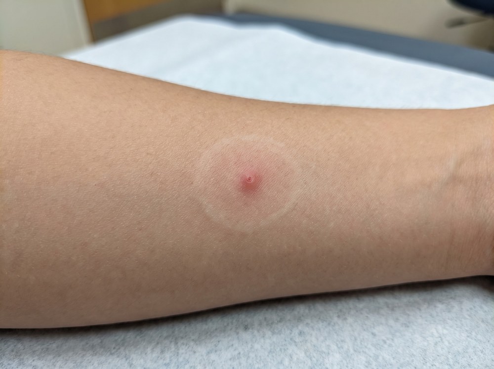 Close-up photo of a small red bump with mild surrounding swelling on human skin consistent with a mild spider bite